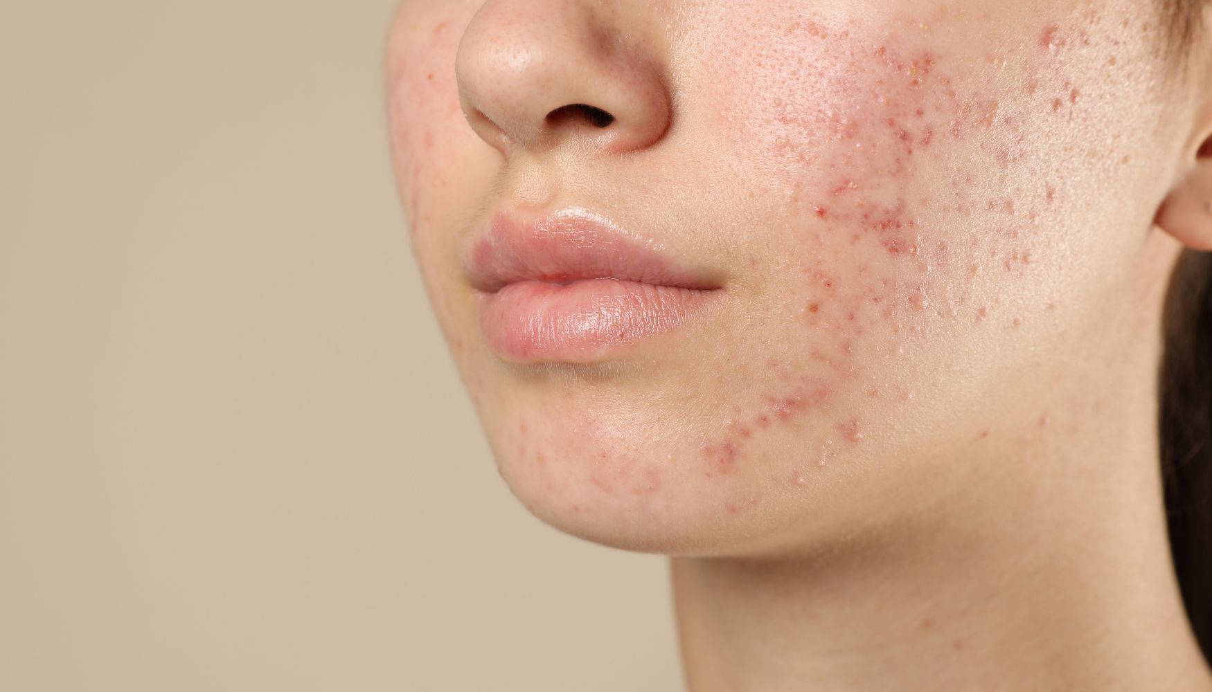 Alcohol and Acne: How Drinking Affects Your Skin Health